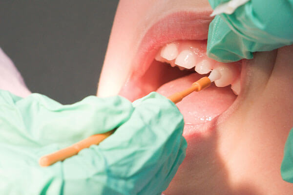 Closeup of fluoride being applied to child's teeth
